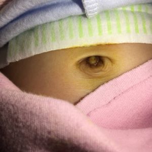 宝宝脐湿总不好？详解病症原因、清热燥湿治法、外用制剂与护理技巧