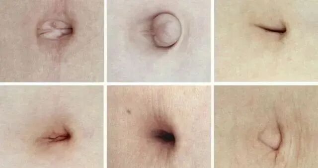 肚脐形状与健康密码：从诊病到保健的全方位解析？插图