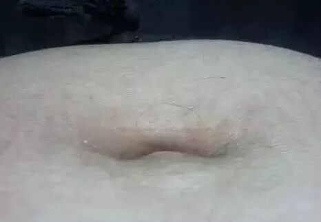 肚脐形状与健康密码：从诊病到保健的全方位解析？插图1