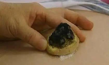 肚脐形状与健康密码：从诊病到保健的全方位解析？插图3