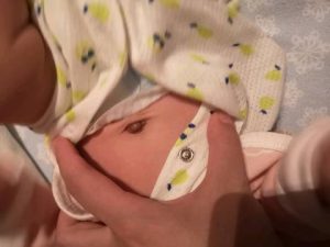 宝宝脐湿总不好？详解病症原因、清热燥湿治法、外用制剂与护理技巧插图1