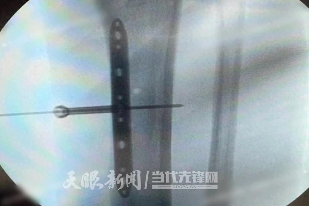 贵州中医大一附院 “保足战役”：中西医结合，成功拯救 76 岁老人糖尿病足