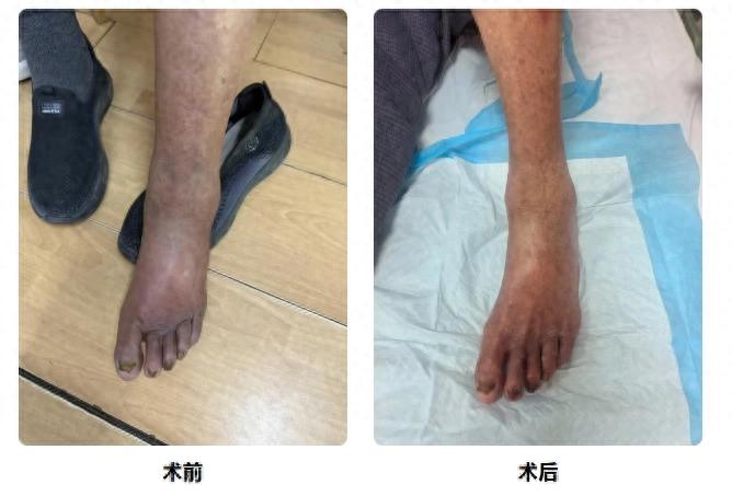 广州医科大学附属中医医院专家帮扶黔南州中医医院，如何用介入治疗解决高龄老人 “走路难” 问题？插图