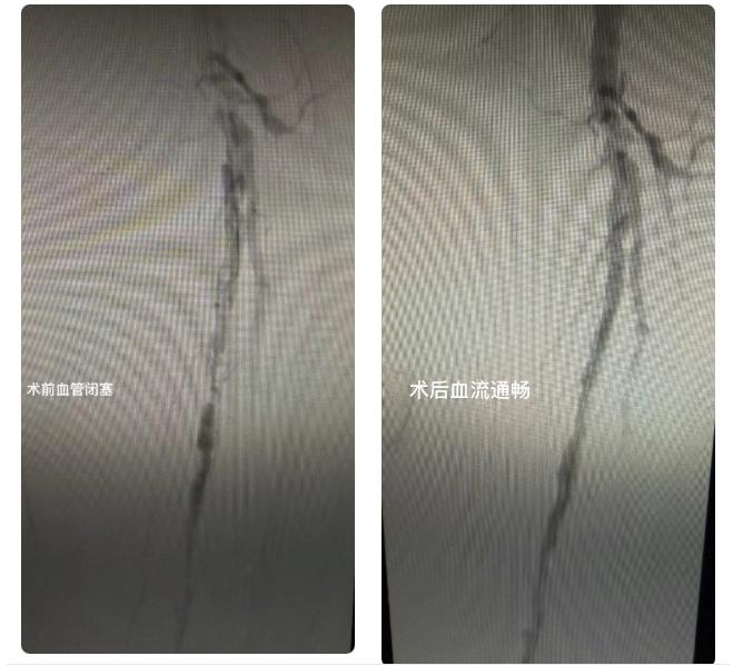 广州医科大学附属中医医院专家帮扶黔南州中医医院，如何用介入治疗解决高龄老人 “走路难” 问题？插图1