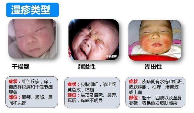 颠痫病儿童能治吗？插图1