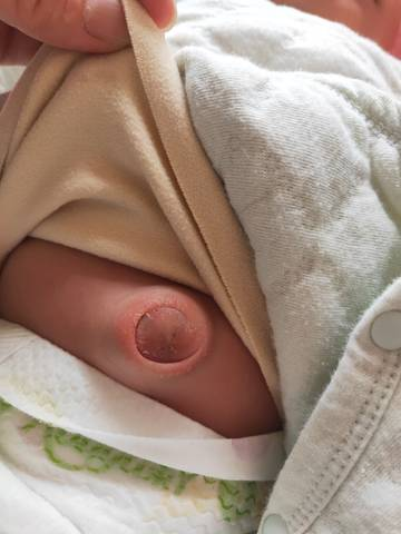 胎儿脐膨出能预防吗？科普病症成因、中医辅助调理、术后用药与孕期保健插图2