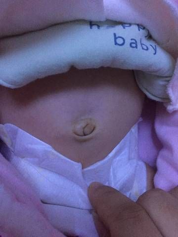 新生儿脐血是怎么回事？解答病症诱因、止血养血疗法、中药选择与预防插图2