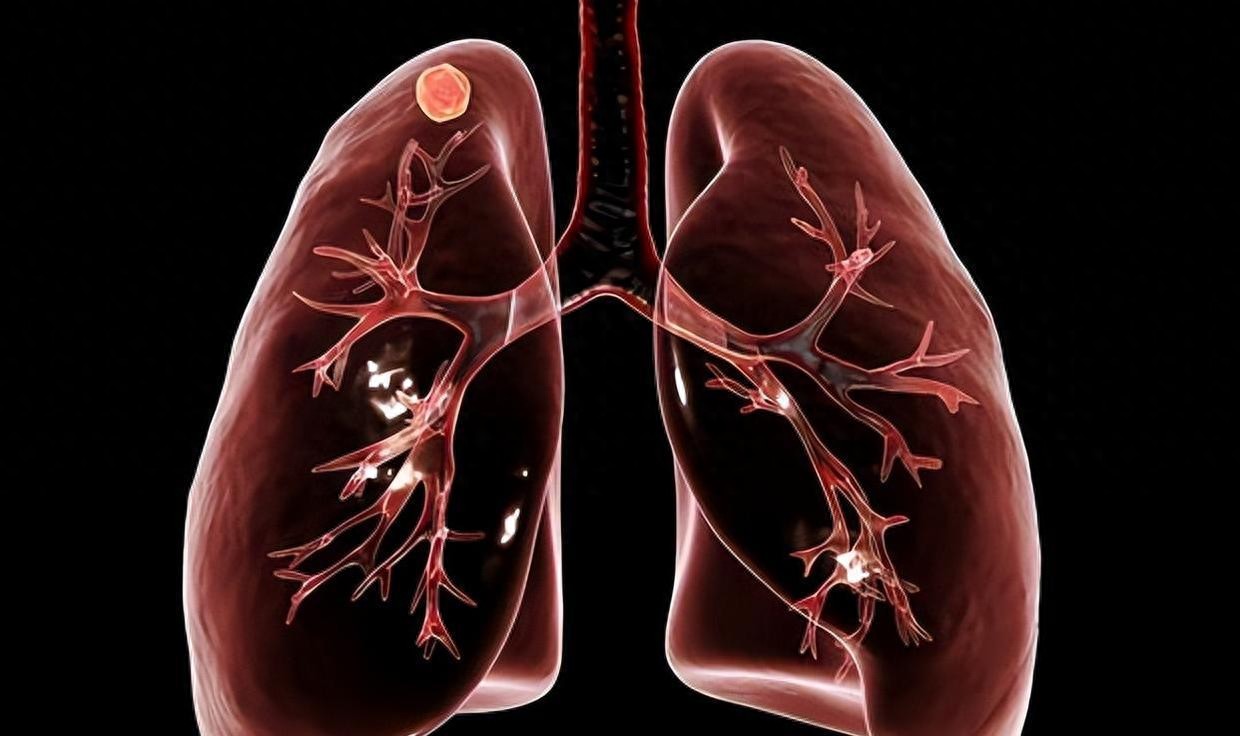 1味中药不起眼，既能清肺毒，又能破痰结，1cm以下肺结节都能消