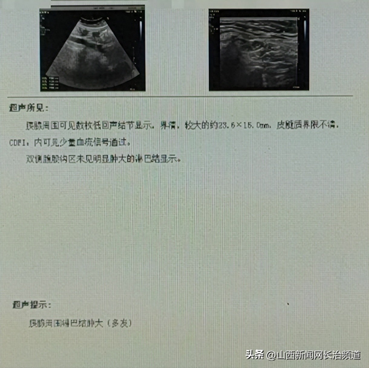 长治市中医医院肿瘤科如何诊断腹腔弥漫大 B 细胞淋巴瘤化疗后复发患者的病情？