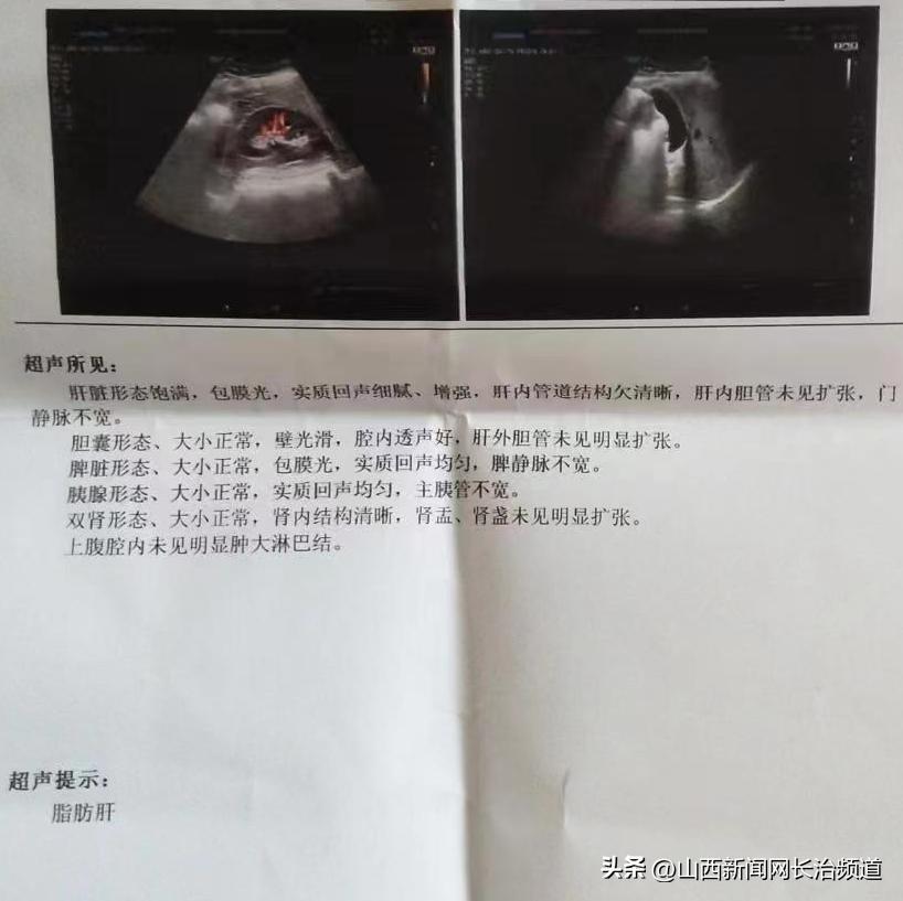 长治市中医医院肿瘤科如何诊断腹腔弥漫大 B 细胞淋巴瘤化疗后复发患者的病情？插图1